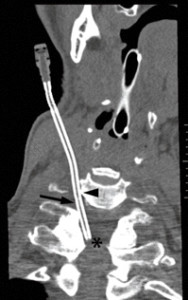 Multidetector computed tomography scan of the catheter inside the cervical spinal canal at C7-T1 (asterisk).  Image source: Anesthesia & Analgesia
