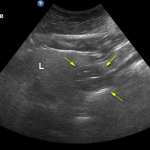 Gastric ultrasonography could be performed in 95% of subjects in the right lateral decubitus position, and in 90% of subjects in the supine position.  Shown is a supine patient’s stomach ultrasound.  L indicates liver and the arrows indicate the grade 2 antrum. (Image source: Anesthesia & Analgesia)