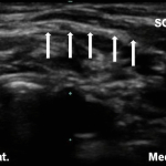 Ultrasound guidance facilitates nerve blocks that can be used for VP shunt revision. (A) Superficial cervical plexus at level of cricoid cartilage, deep to the lateral border of the sternocleidomastoid muscle. SCM – sternocleidomastoid muscle; arrows show deep border of the fascia where superficial cervical plexus is located below the lateral border of the sternocleidomastoid muscle. (Image source: A&A Case Reports)