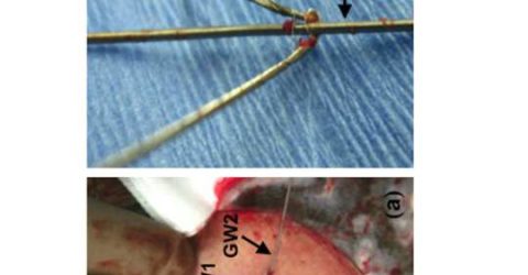 Central venous catheter insertion issues
