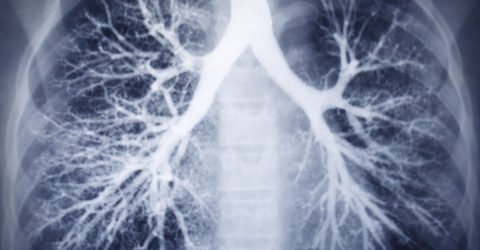 Airway exchange catheters can create lung damage when they extend beyond the carina