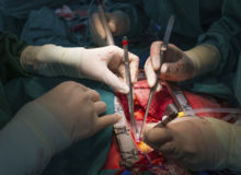 Can the anesthesiologist affect outcome after CABG surgery?  A study from New York (reader note: this article has been retracted)