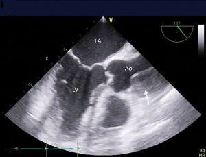 Routine postoperative TEE exam after aortic surgery is instrumental in the early diagnosis of multiple types of complications including retrograde type A aortic dissection. Shown is midesophageal aortic valve long-axis view showing intramural hematoma in the ascending aortic wall. Image source: A&A Case Reports